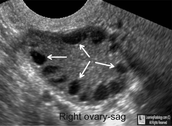 Polycystic Ovary Syndrome
